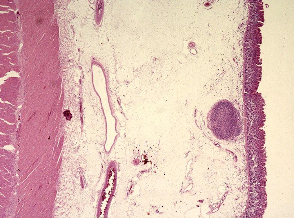 EDEMA Histologic Appearance of Edema Lightly staining eosinophilic fluid (if some protein