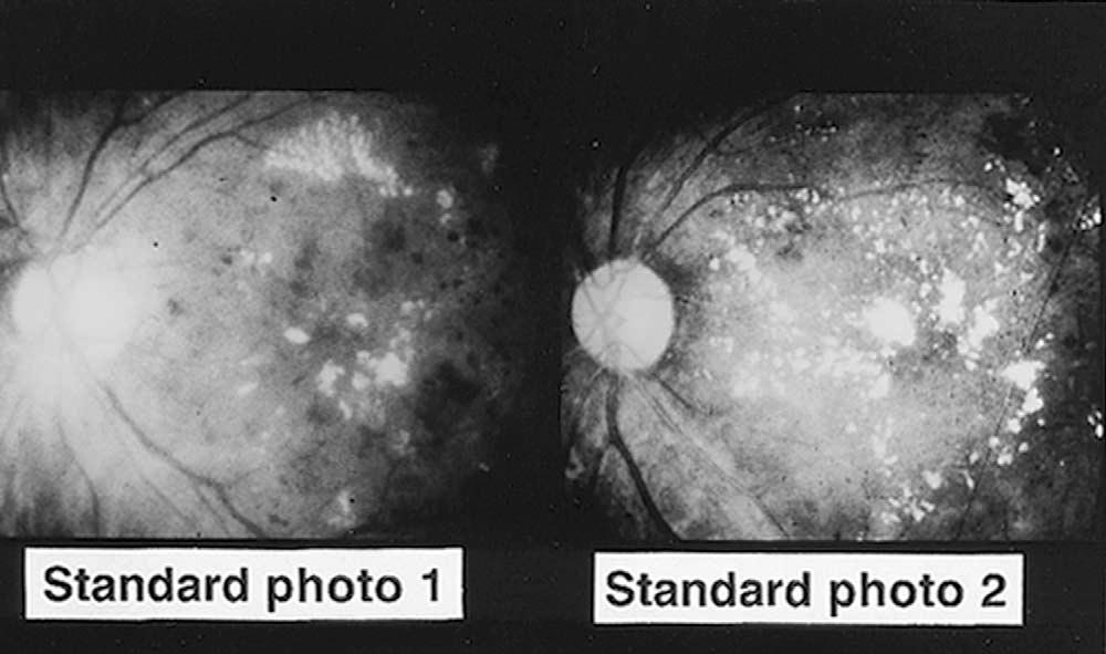Y. SATO ET AL. 317 VITRECTOMY FOR DIABETIC CME Figure 1. Standard photos used to determine the degree of hard exudate deposition in the macula.