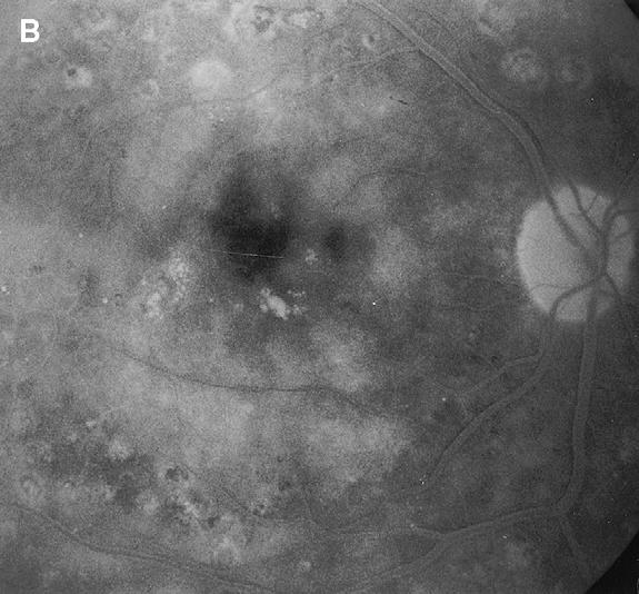 Complications are possible. Iatrogenic retinal tears were observed frequently during creation of a posterior vitreous detachment, but no postoperative retinal detachment occurred.