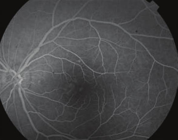 226 Inravitreal Dexamethasone Implantation in A Patient with Persistent Macular Edema.
