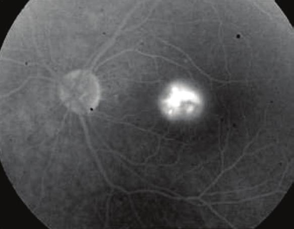Increasing fluorescein leakage in the late venous phase of the fundus fluorescein angiography in the left eye (b).