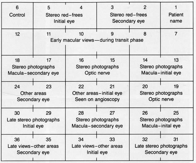 18 Journal of Ophthalmic Photography Vol. 11, No. 1 August 1989 Fig 4: Photographic sequence for patients with macular degeneration or cystoid macular edema. (Schatz H.