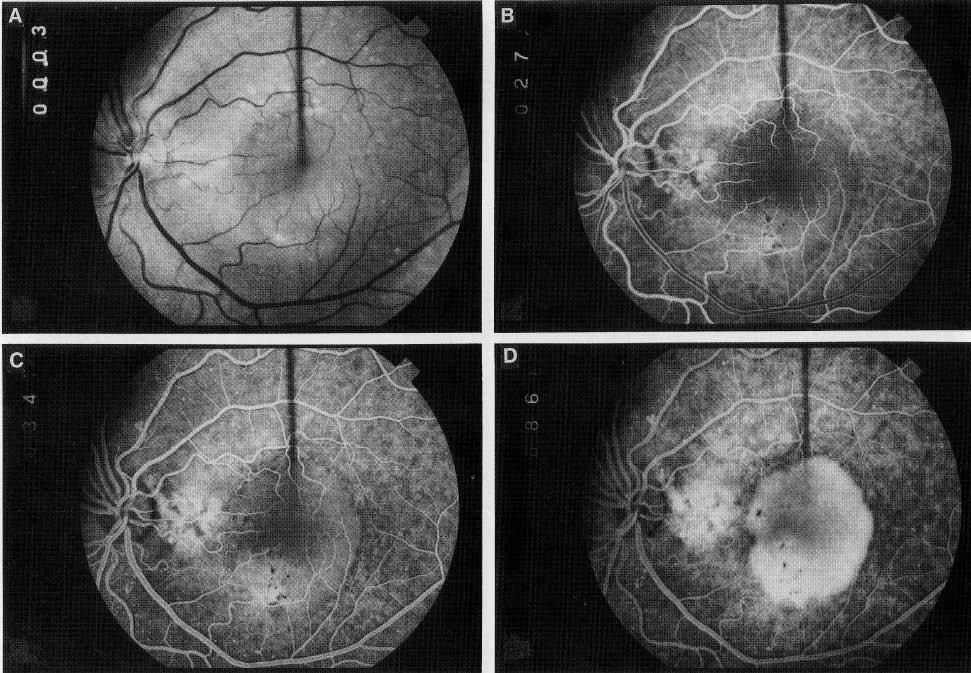 ) Fig 5 (Below): (A) The red-free photograph accentuates a serous detachment of the retinal pigment epithelium, drusen, and pigment changes in the left eye of patient with macular degeneration.