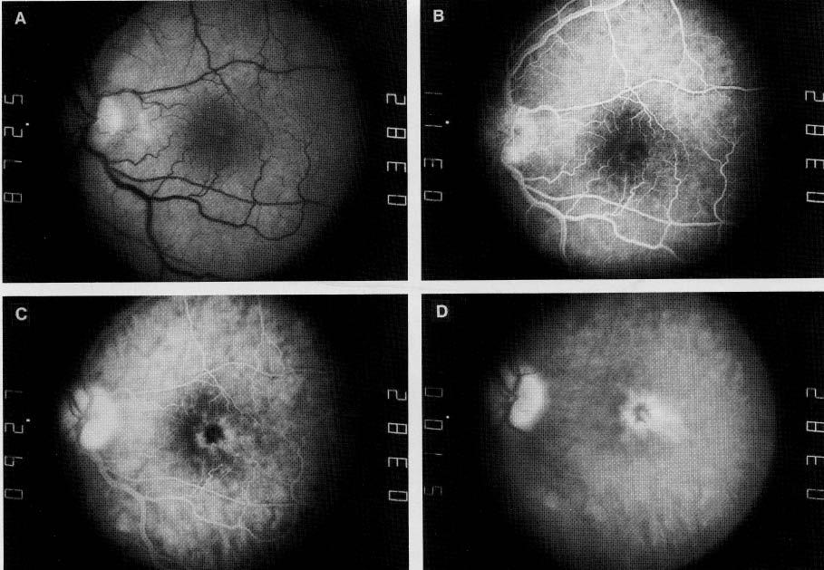 Ruth E. Picchiottino, CRA Disease-Specific Fluorescein Angiography 19 Fig ß: (A) In cystoid macular edema, red-free photograph shows cystic spaces at the fovea.