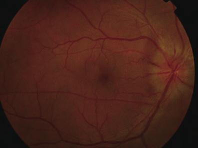 Fig. 12--1 Fundus images at the initial visit showing disc edema and a