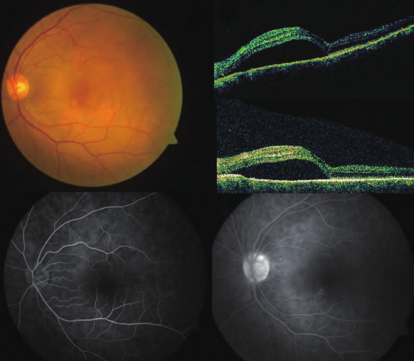 t 2 weeks, the amount of subretinal fluid increased in the left eye and new serous retinal detachment was found in the right eye (Fig. 12--6). F findings didnot confirm VKH disease (Fig. 12--6). OT displayed serous macular detachment in both eyes (Fig.