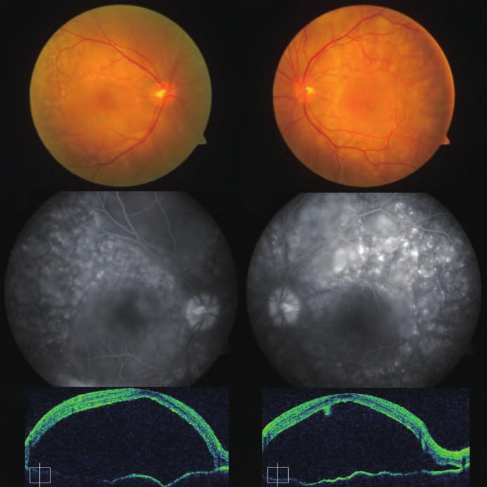 Fig. 12--7 () t weeks, serous macular detachment was aggravated in both eyes.