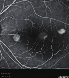 efore being referred to a retinal consultant, he had visited a general ophthalmology clinic and been prescribed oral steroid under the impression of