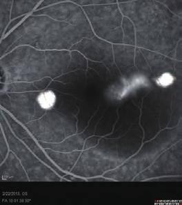 Fundus examination revealed multiple pigment epithelial detachments (PEDs) in both eyes and serous macular detachment in the left eye (Fig. 12--9).