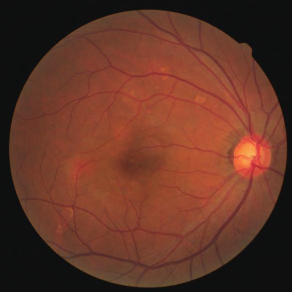 OT showed multiple PEDs in both eyes and serous retinal detachment on the macula in the left eye (Fig. 12--11).