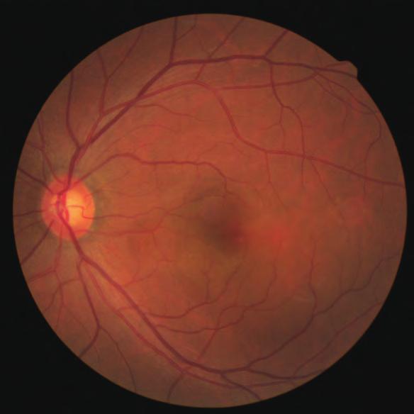 2mg) at a 6-week interval. fter bevacizumab treatment, serous macular detachment was resolved and vision improved to 0.8 in the left eye. Fig.
