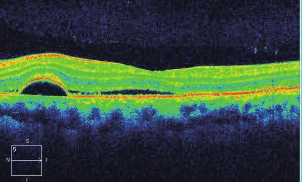 Optic disc hyperemia and edema can often be seen in VKH, and optic nerve head changes with little or no exudative retinal detachment in the early stage of VKH could be mistaken for optic neuropathy