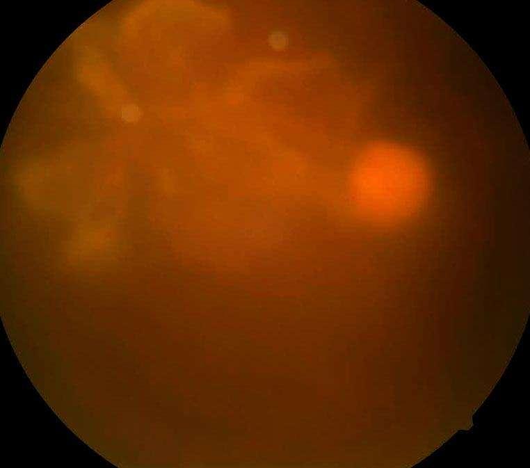 Case 3: January 23, 2015 Right eye: Cannot detect retina due to