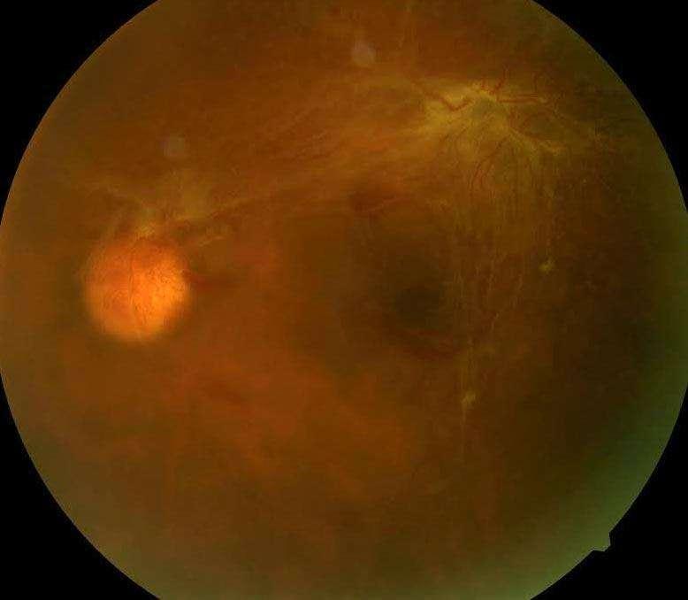 Case 3: January 23, 2015 Right eye: Cannot detect retina due to