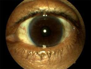 Left eye: Extensive neovascularization Fibrous proliferation Preretinal