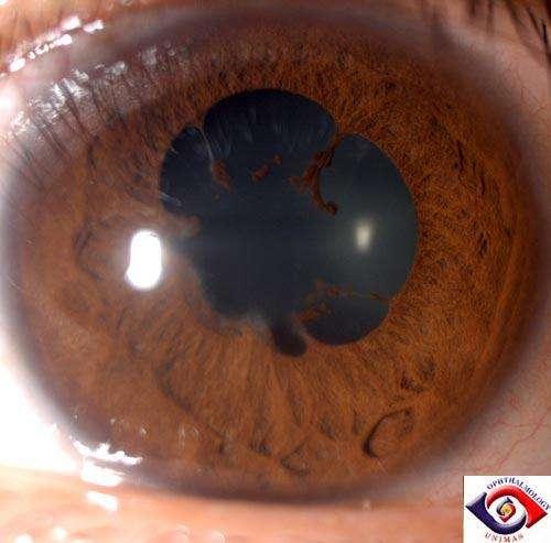 episode in 1996 Diagnosed as idiopathic uveitis, treated with corticosteroid eye drops Presented to ophthalmology clinic in 2008 with