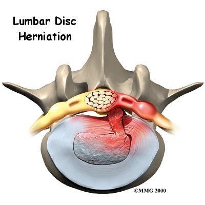 utside f the annulus, this is called a prtrusin r herniatin. If the disc leaks ttally ut f the cnfines f the annulus, this is called an extrusin.