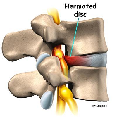 When disc degeneratin ccurs, it becmes less effective at its twin tasks f hlding vertebrae tgether and absrbing shck.