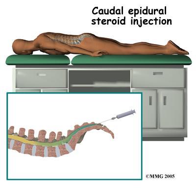 Caudal Epidural Injectin Lumbar Facet Injectin Sacriliac Jint Injectin The spinal canal can be entered thrugh the midline