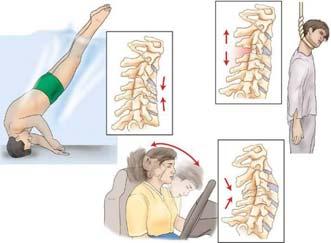 Injuries to the Spine Mechanism of injury Compression Falls Diving accidents Motor vehicle accidents Excessive flexion, extension, rotation Lateral bending Distraction Pulling apart of the spine