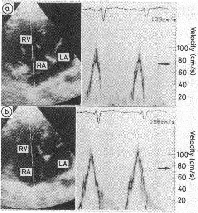 The alignment of the ultrasound beam is shown by a highlighted line passing from the right ventricle (RV) to the right atrium (RA).