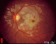 ??????? Patient may report sudden vision loss/blurriness VITREOUS HEMORRHAGE Patient may complain of dim vision, may see pink or red, and