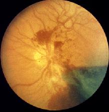 and management of underlying cause Patient must get treatment within first hour for best outcome. After 4 hours vision loss may be permanent.