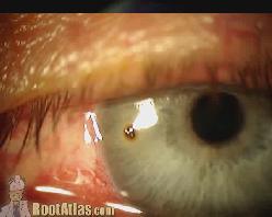 RETINAL DETACHMENT FOREIGN BODY REMOVAL Patient may report flashes, floaters, or a curtain over