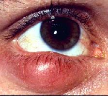 be cellulitis infection of the lid and surrounding tissue Infection can come from untreated