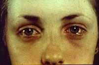 detachment SWOLLEN LIDS Patient may report lids became swollen very quickly and have severe