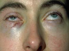 TRAUMA Any patient reporting any trauma to the eye should be