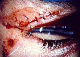 of the orbit Corneal abrasion Eyelid laceration Penetrating