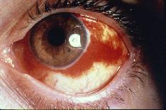 infection Hordeolum Temporal Artery Pain Optic neuritis