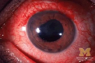 Peri-limbal injection Can cause increased pressure