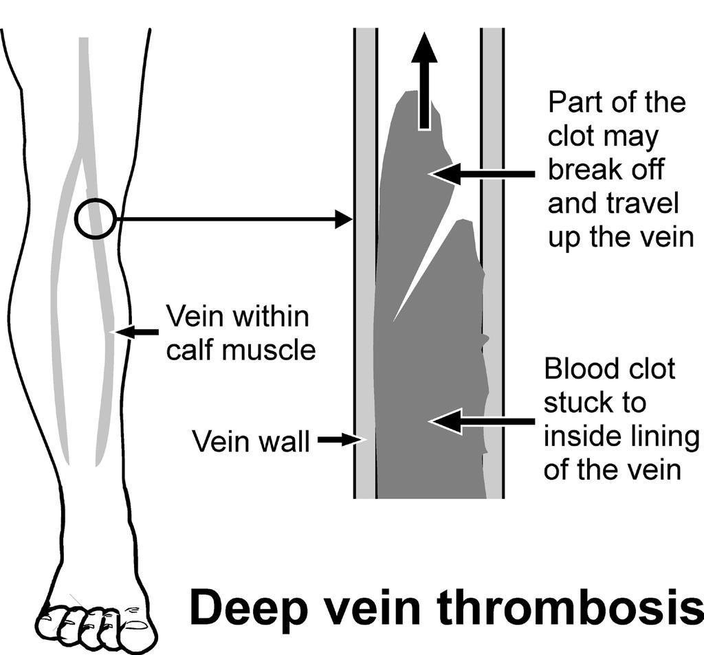 Listening in order to improve Always doing what we can to be helpful Deep Vein Thrombosis and Anticoagulants What is a deep vein thrombosis?