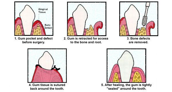 11 o Reshaping the Bone We may send you to a specialist to perform osseous (bone) surgery to reshape the bone.