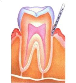 A periodontal probe is the instrument your dentist uses to measure your gingival, or gum, pockets. Healthy gums shouldn t bleed or feel tender when you floss or brush.