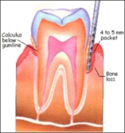 6 In Stage 2, you may have pockets measuring 3 to 5 millimeters, calculus beginning to progress below the gumline, and some bone loss. Ligaments may become damaged at this stage, which loosens teeth.