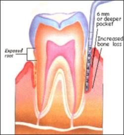Pus pockets may begin to form, and there may be more bone loss. You may lose your teeth during this stage.