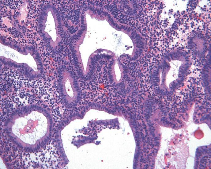 Simple hyperplasia without atypia: The endometrium shows an increase in the glandular epithelium that