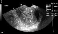 Endometrial hyperplasiashows diffuse