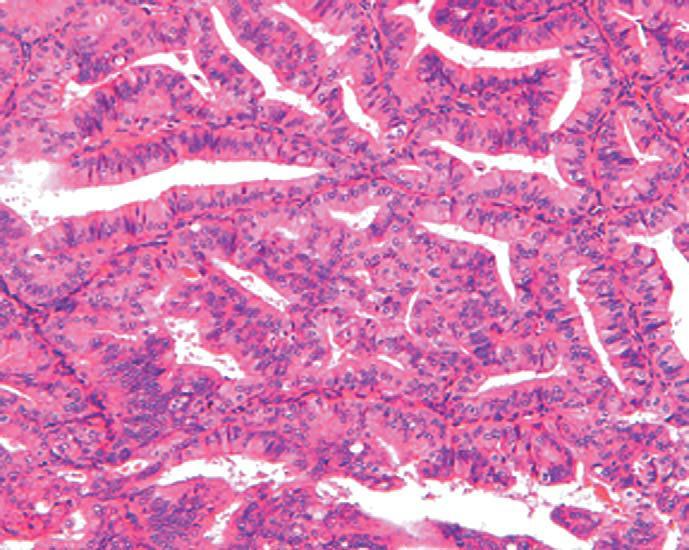 Well-differentiated endometrioid adenocarcinomas a back to back glandular