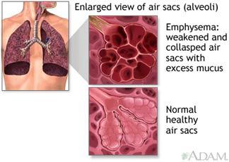 .. Is a condition of the lungs where there is an abnormal increase in