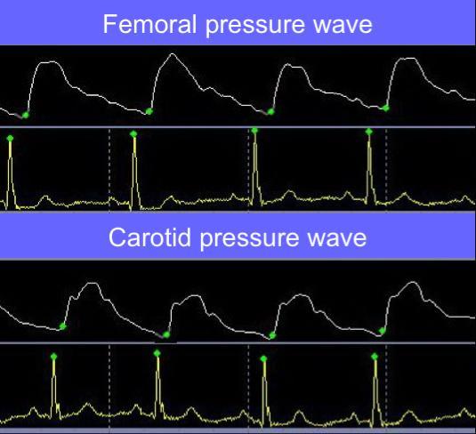Pressure waveform ECG Pressure waveform ECG Figure 3.3 Aortic pulse wave velocity was determined from sequential pressure waveform measurements at carotid and femoral sites.
