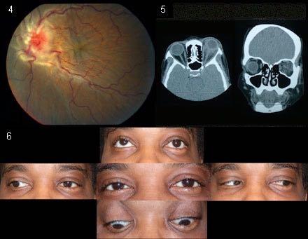 Eye Examination Ocular Motility Alignment Ductions Versions Peripheral Vision