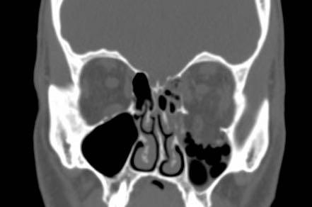 Orbit Floor Fractures Most common type of orbital fracture Thin maxillary bone medial to infraorbital neurovascular bundle Bone is 0.
