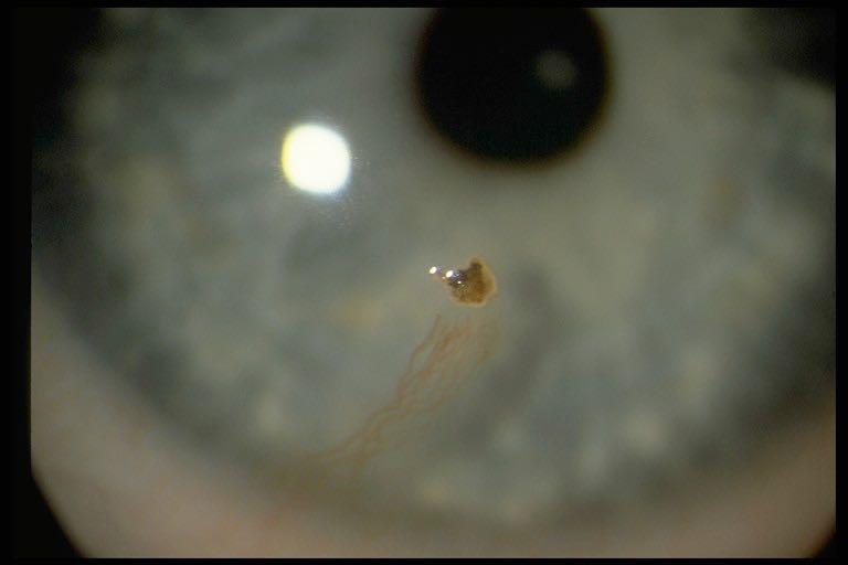 Foreign Body Sensation Dry Eye Blepharitis, Conjunctivitis Abrasion