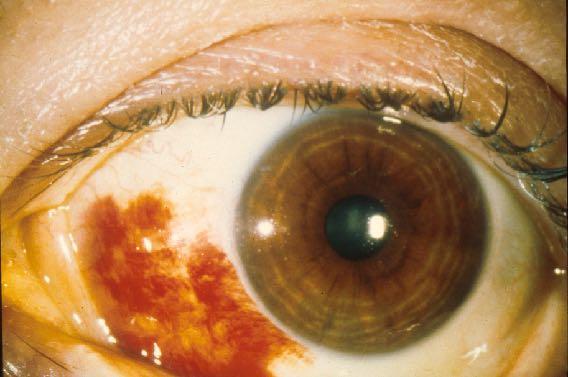 Subconjunctival Hemorrhage Dramatic but harmless Sneezing,coughing, straining,eye rubbing Associated with: