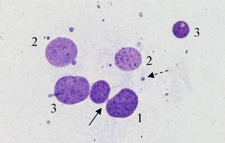 The figure shows a binucleated cell with a micronucleus laying over a nucleoplasmic bridge (dashed arrow) and another two micronuclei (solid