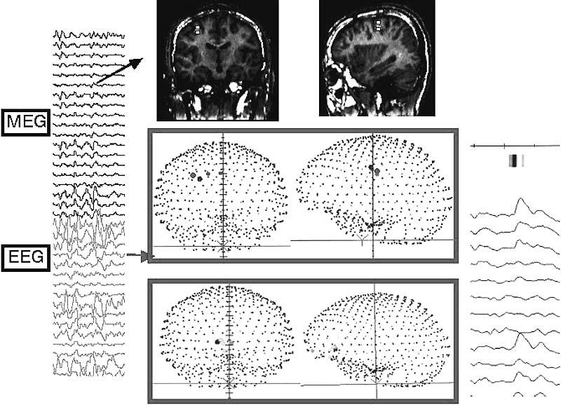 SIMULTANEOUS EEG-MEG DIPOLE 927 FIG. 2. The upper portion of the figure shows magnetoencephalography (MEG) dipoles.